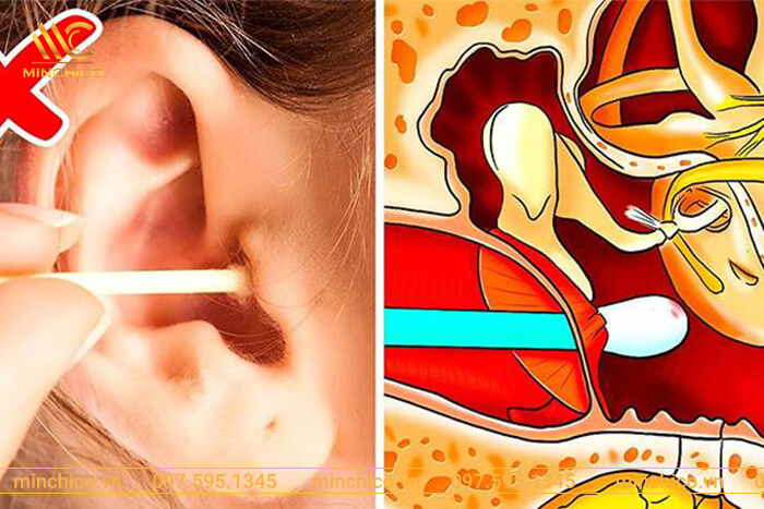Lưu ý quan trọng khi xử lý nước vào tai khi đi bơi Lưu ý quan trọng khi xử lý nước vào tai khi đi bơi